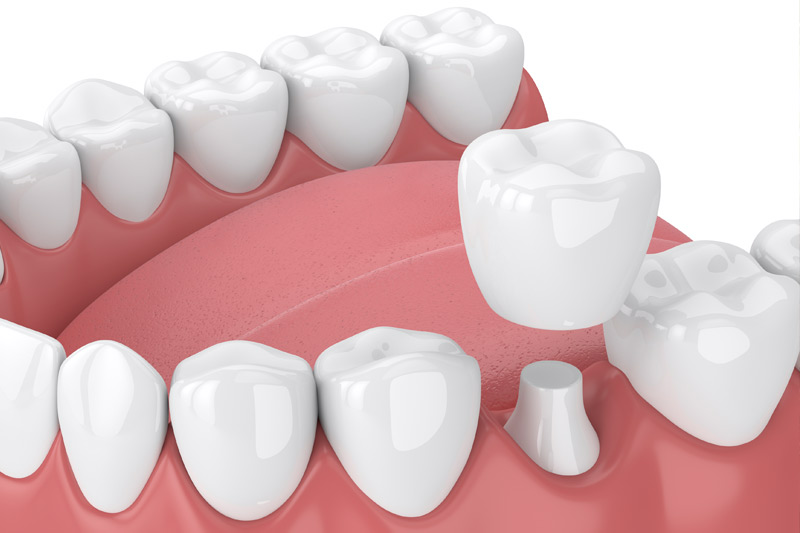 Dental Crowns in Hoffman Estates