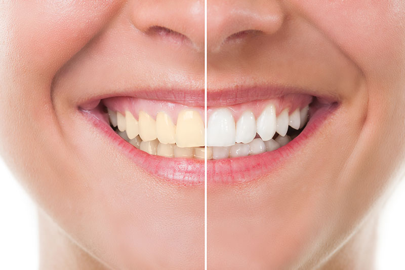 Teeth Whitening in Hoffman Estates